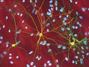 Neuroni di un soggetto colpito da Corea di Huntington (fonte: Dr. Steven Finkbeiner, Gladstone Institute, Taube-Koret Center and the University of California San Francisco) (ANSA)