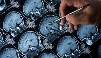 Un'alterazione genetica rende aggressivi tumori al cervello (ANSA)