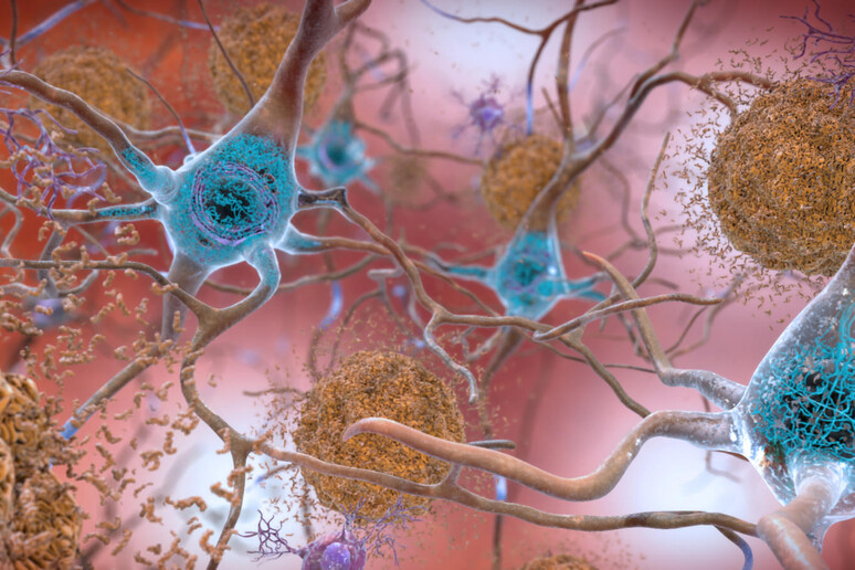 Rappresentazione artistica delle placche dell 'Alzheimer (fonte: NIH Image Gallery) - RIPRODUZIONE RISERVATA