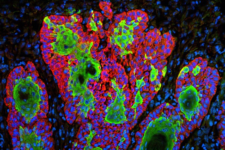 Cellule tumorali (fonte: ZEISS Microscopy da Flickr) - RIPRODUZIONE RISERVATA